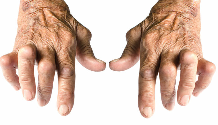 7 things to avoid to manage rheumatoid arthritis