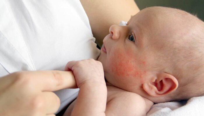 Prevent these infant skin issues to keep your baby’s skin flawless