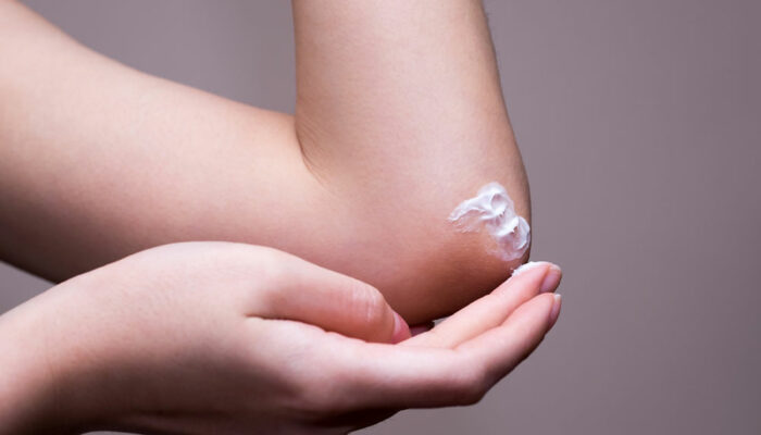 Top 7 topical lotions for managing eczema flareups