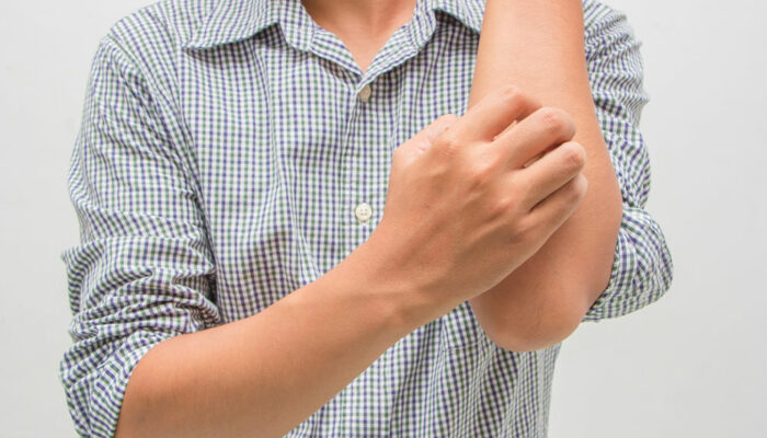 10 warning signs of eczema to watch out for